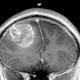 Renonancia magnética con un gioblastoma. Foto: Wikipedia